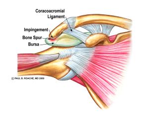 Impingement