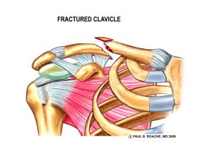 Fractured Clavicle Color