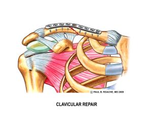 Clavicular Repair Color