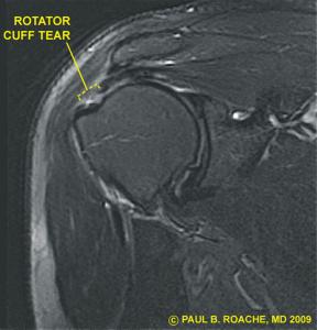 MRI of Tear