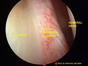 Arthro Intact Labrum