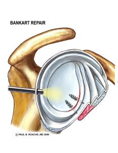 Bankhart Repair