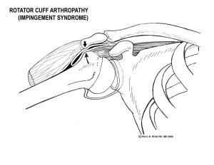 Impingement Compression